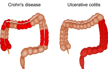 Crohn disease and Ulcerative colitis